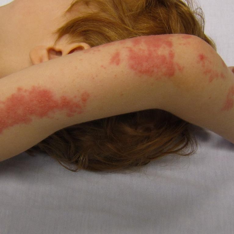A child with a rash caused by shingles on their arm.