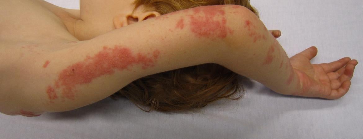 A child with a rash caused by shingles on their arm.